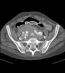 Pelvic Bleed From Iliac Aneurysm - CTisus CT Scan