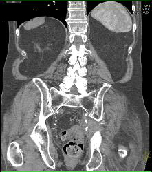 Pelvic Bleed From Iliac Aneurysm - CTisus CT Scan