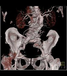 Fem-fem Bypass - CTisus CT Scan