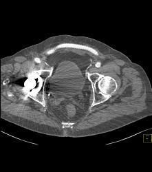 Fem-fem Bypass - CTisus CT Scan