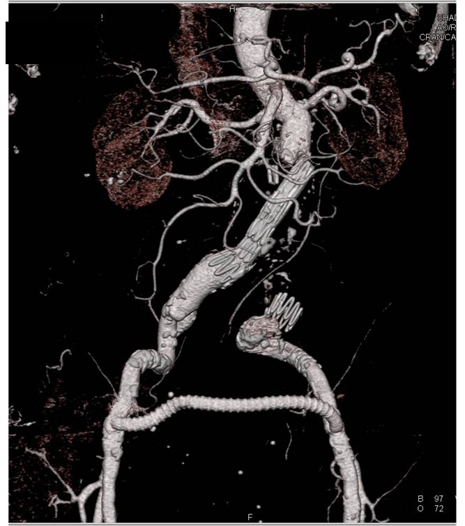 Endovascular Stent with Occluded Limb - CTisus CT Scan