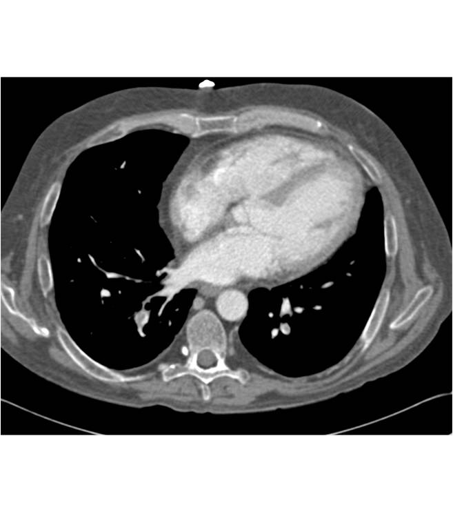 Incidental Pulmonary Emboli (PEs) in a Patient with a Liver Abscess - CTisus CT Scan