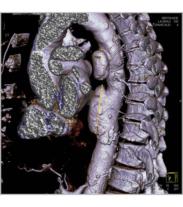 Focal Ulcerations of the Thoracic Aorta Seen With 3D Mapping - CTisus CT Scan