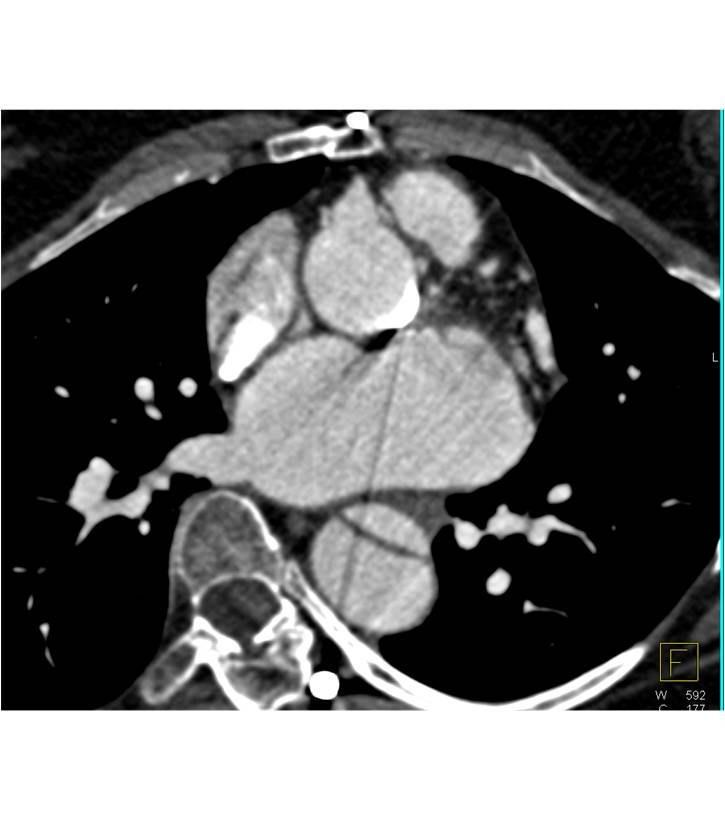 Dissection Nicely Shown in 3D With Complex Extension into the Abdomen - CTisus CT Scan