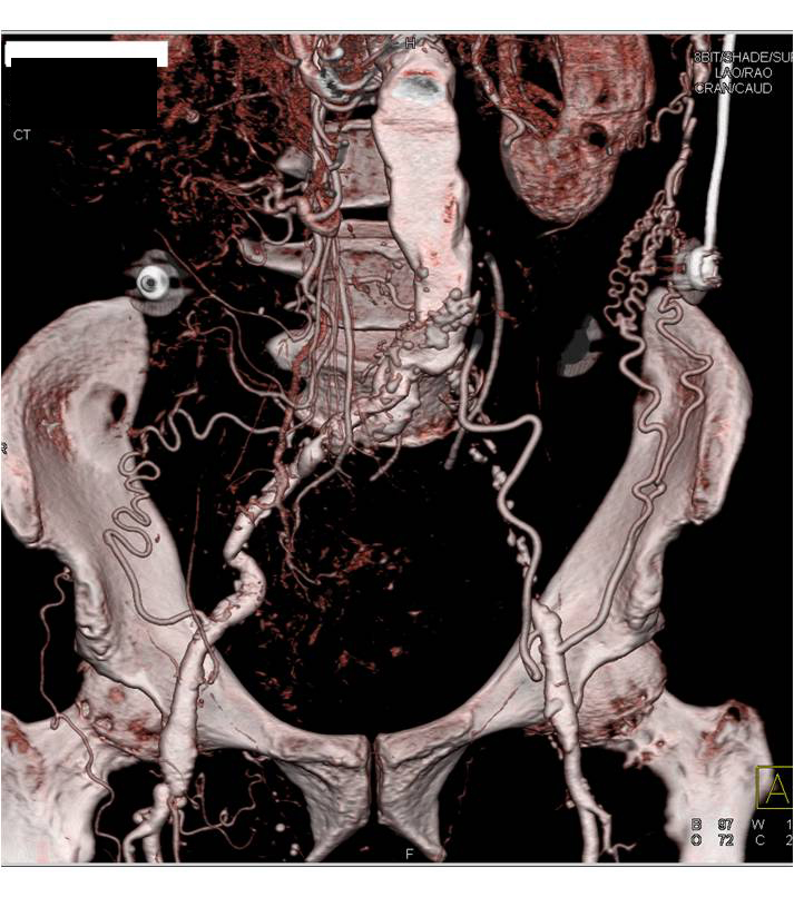 Occlusion of Iliac Arteries with Extensive Collaterals Defined - CTisus CT Scan