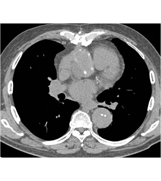 Repair of Aortic Root and Aortic Valve Replacement (AVR) with Dissection seen in Descending Thoracic Aorta and Abdominal Aorta into Iliacs - CTisus CT Scan