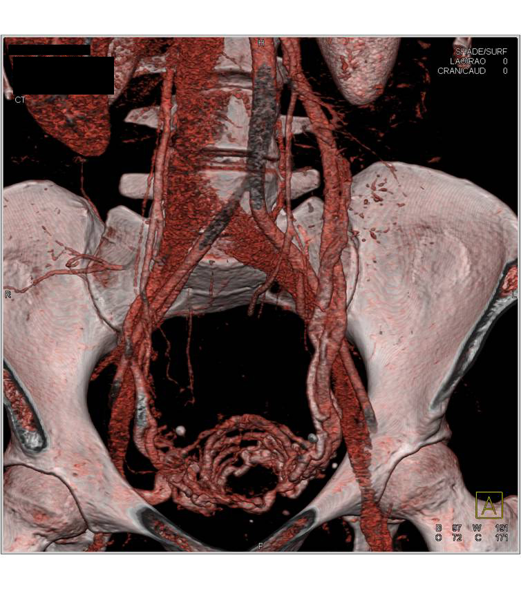 Pelvic Congestion Syndrome - CTisus CT Scan