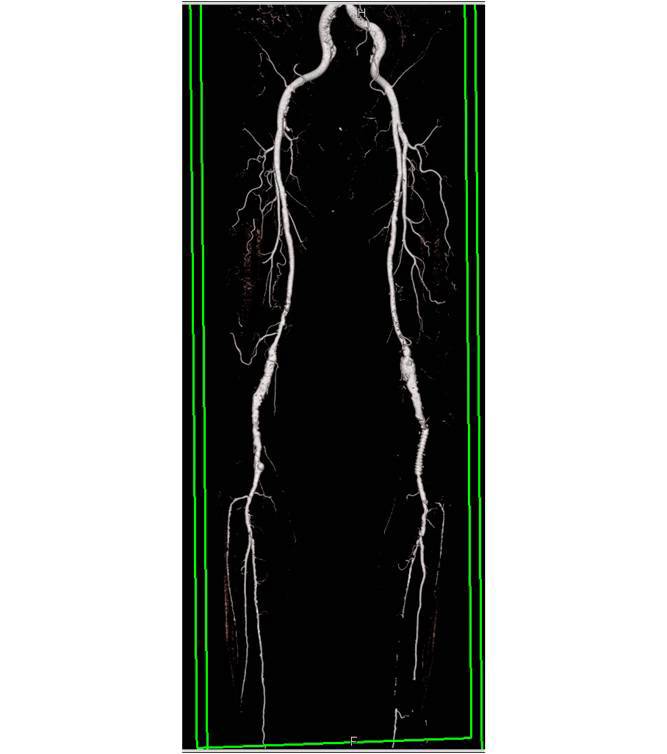 CTA Runoff Study with Nice Definition of Bone Editing as well as stents and areas of Stenosis - CTisus CT Scan