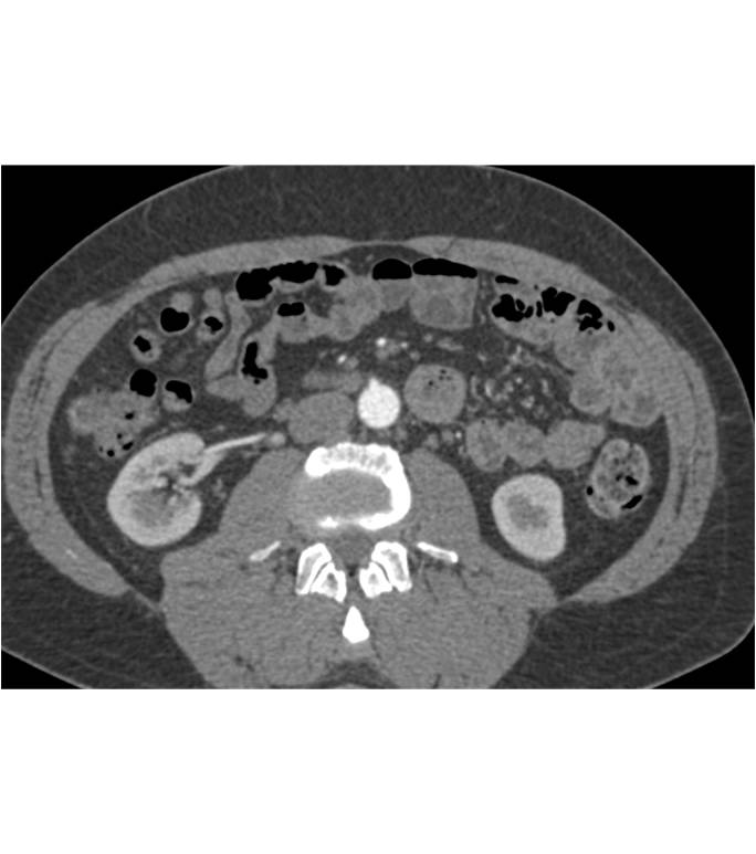 Mild Right Ureteropelvic Junction (UPJ) due to Renal Artery and Vein Crossing. Note 2 Right Arteries and Veins - CTisus CT Scan