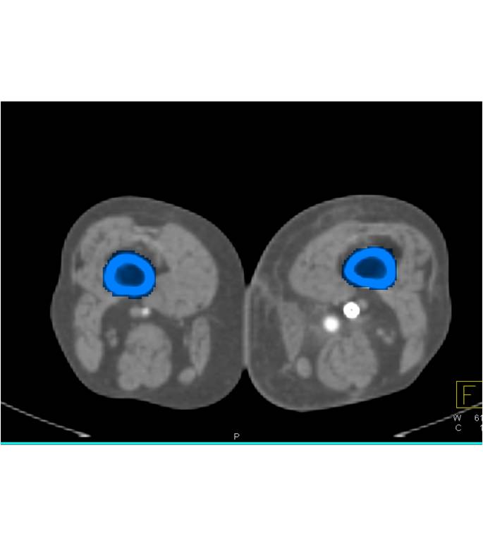 Left Superficial Femoral Artery (SFA) to Popliteal Artery Bypass Graft with Good Visualization of Bone Editing Images as well as Peripheral Vascular Disease (PVD) on the Right - CTisus CT Scan