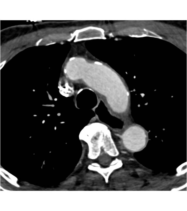 3D Mapping of Dilated Ascending Aorta and Root with Coronary Artery Disease also seen - CTisus CT Scan