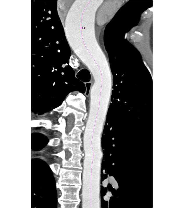 Vascular Mapping of Dilated Ascending Aorta and Root with Advanced Visualization Tools - CTisus CT Scan