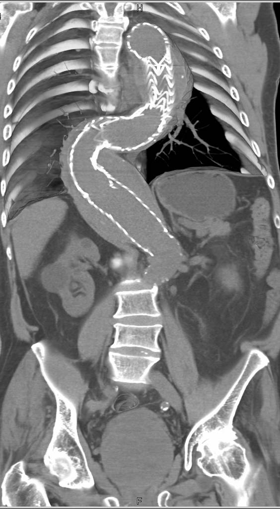 Endovascular Stent and Stent in Right Renal Artery - CTisus CT Scan