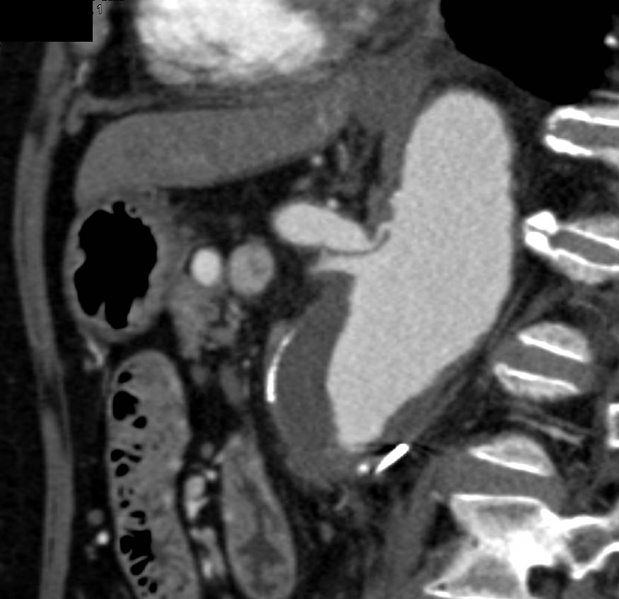 Aortic Aneurysm with Celiac Stenosis and Increased Flow through Gastroduodenal Artery (GDA)-Excellent Example of Collateral Pathway - CTisus CT Scan