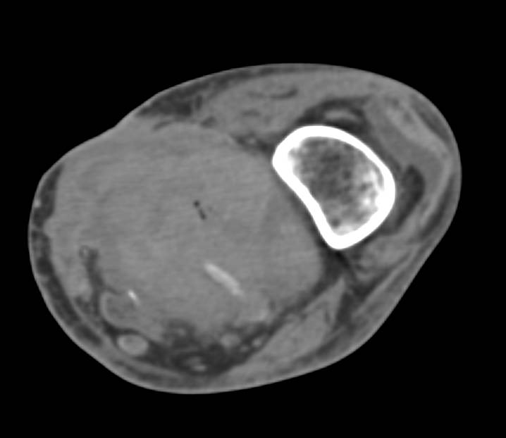 Hematoma in the Popliteal Fossa in a Patient with Endovascular Graft - CTisus CT Scan