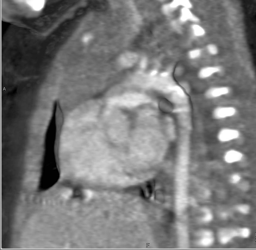 Coarctation of the Aorta S/P Repair - CTisus CT Scan