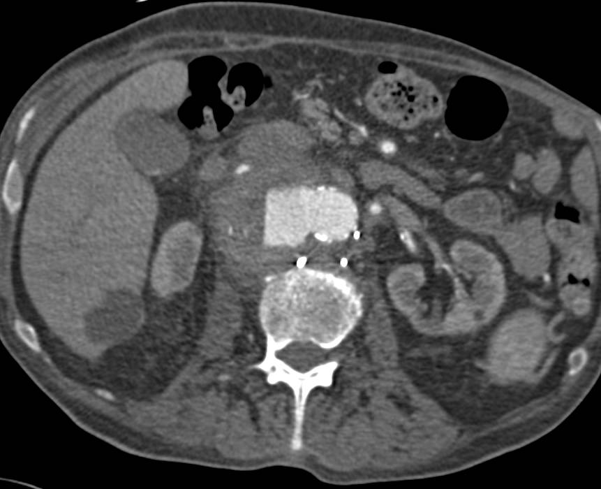 Aortic Aneurysm with Ulceration and Periaortic Bleed - CTisus CT Scan