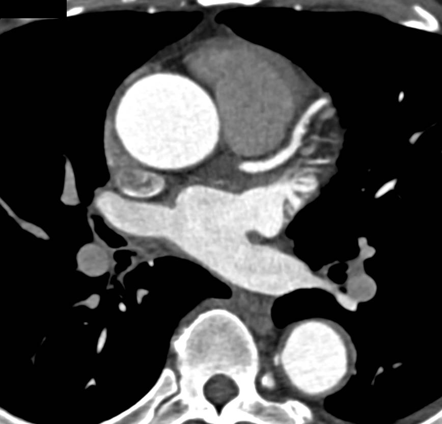 Dilated Ascending Aorta as well as Coronary Artery Disease - CTisus CT Scan