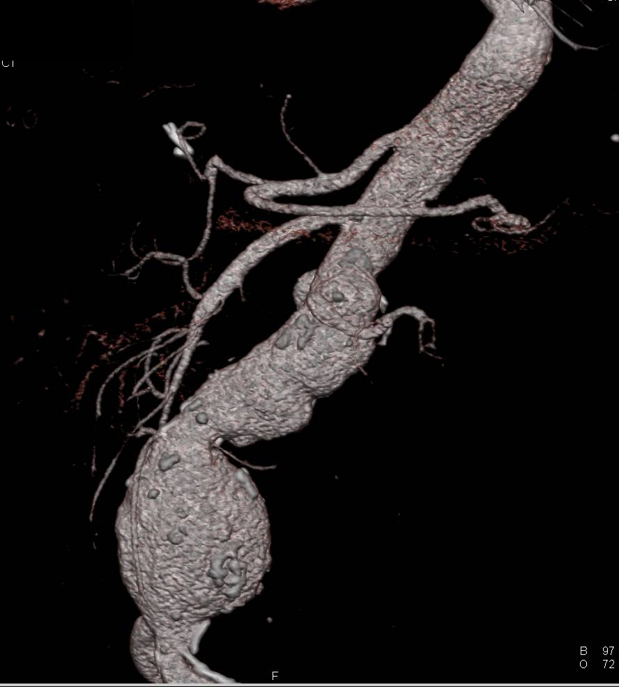 Abdominal Aortic Aneurysm with Vascular Mapping - CTisus CT Scan