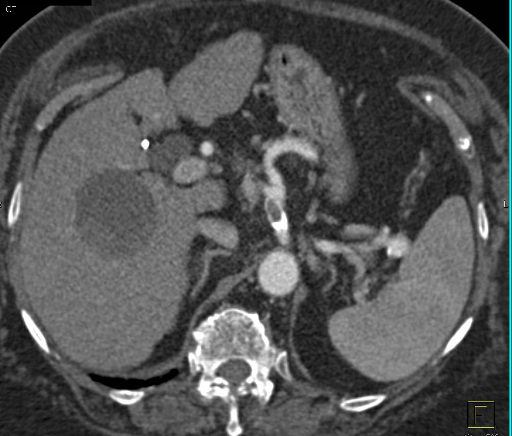 Clot in the Celiac Artery - CTisus CT Scan