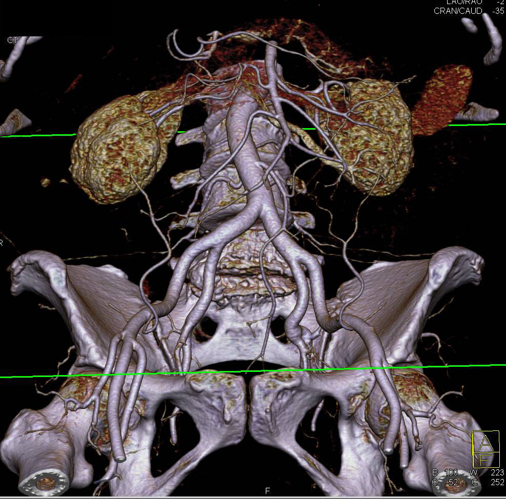 Beautiful 3D Display of Aorta and Iliac Bifurcation and Vessel Branching - CTisus CT Scan