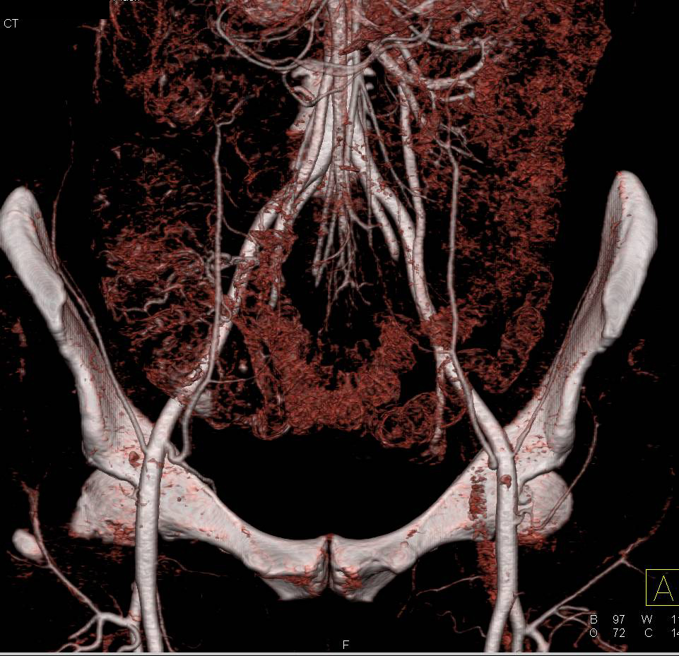 Normal Iliac Arteries - CTisus CT Scan