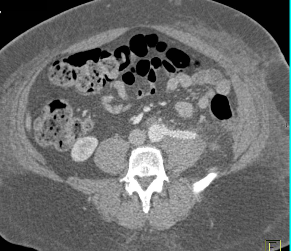 3D Mapping of Vascular Bypass Grafts both Patent and Occluded - CTisus CT Scan