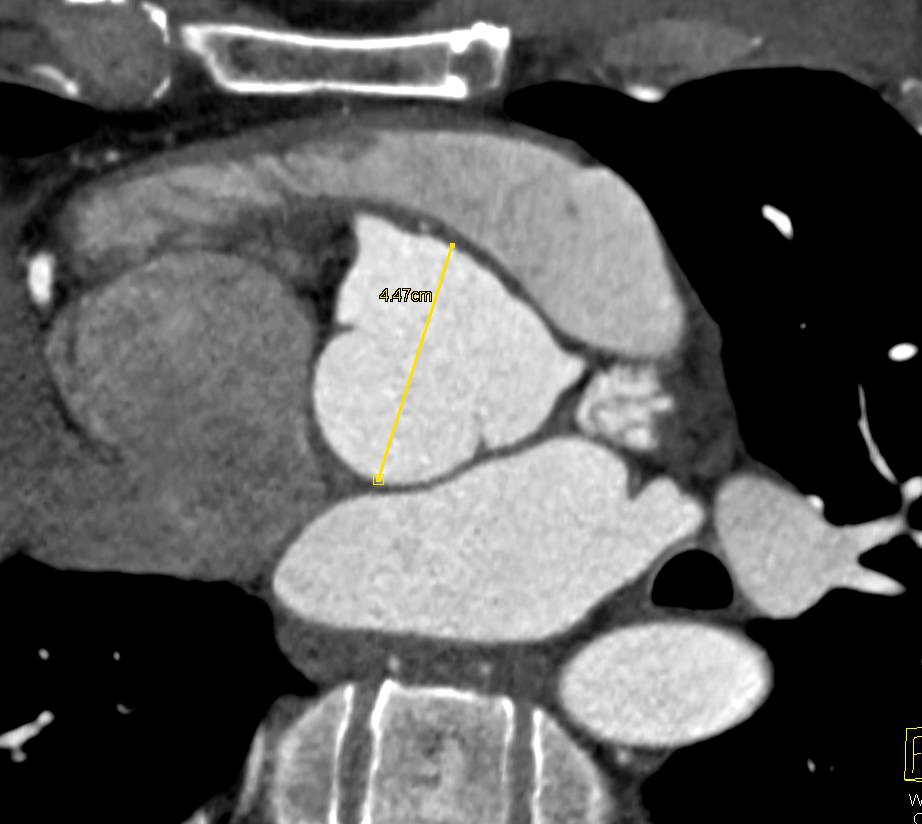 Dilated Aortic Root in Marfan Patient - CTisus CT Scan