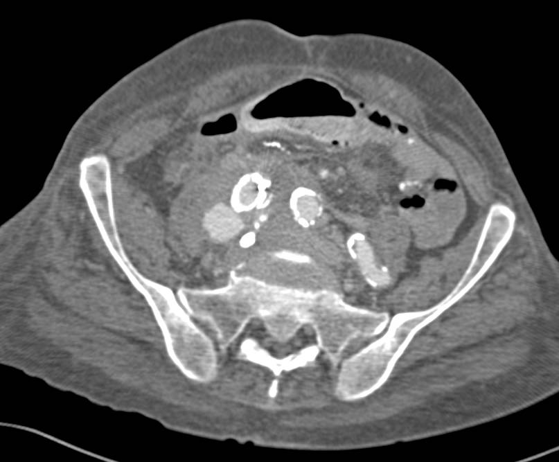 Endoleak from a Stent in the Right Iliac Artery - CTisus CT Scan