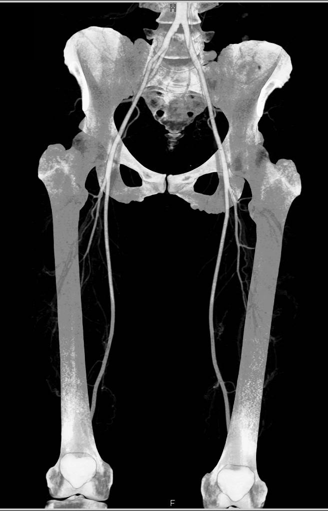 CTA Runoff Study with Bone Removal and Vascular Mapping - CTisus CT Scan