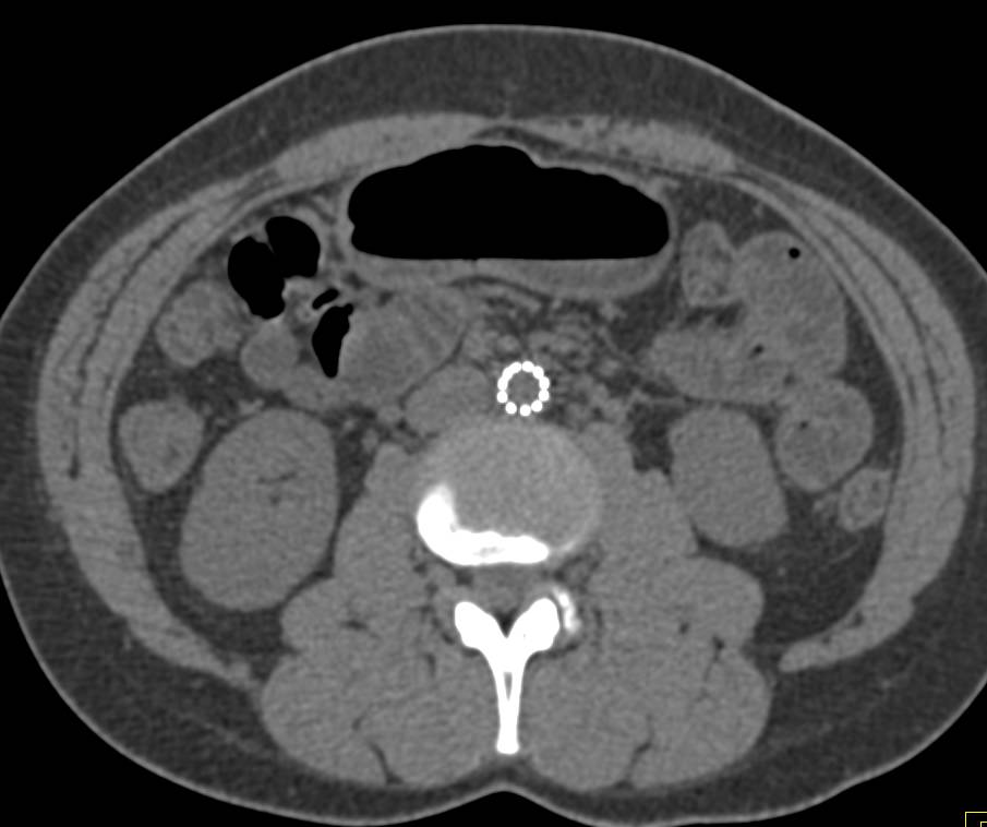 Near Occlusion of Aorta Just Above a Previously Placed Endovascular Stent - CTisus CT Scan