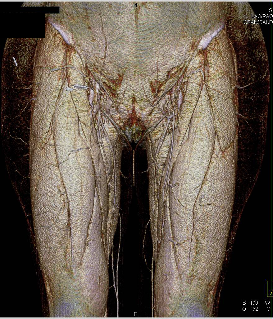 CCTA Run-off with Bone Editing and Display with VRT and MIP - CTisus CT Scan