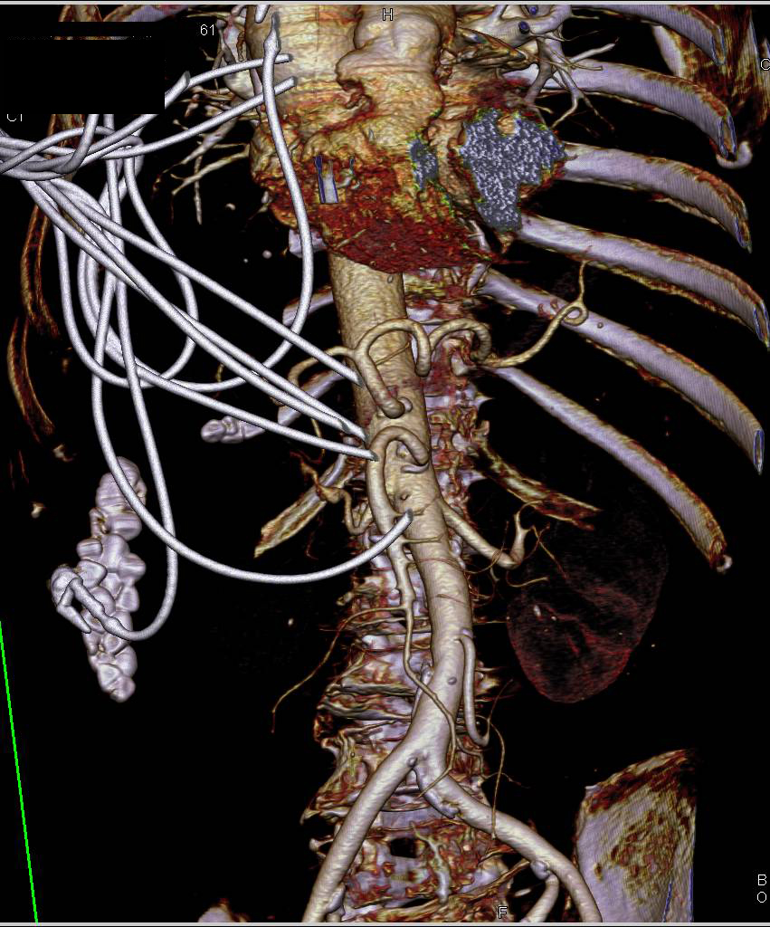 Opaque VRT of Mesenteric Vessels Including Superior Mesenteric Artery (SMA), Celiac and IMA - CTisus CT Scan