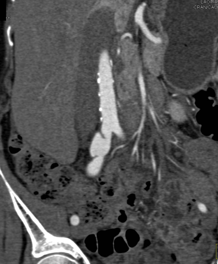 Focal Aneurysm and Dissection Right Common Iliac Artery - CTisus CT Scan