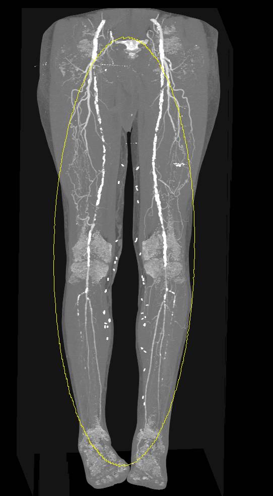 Dual Energy Runoff Study with Peripheral Vascular Disease with Calcium Removal - CTisus CT Scan