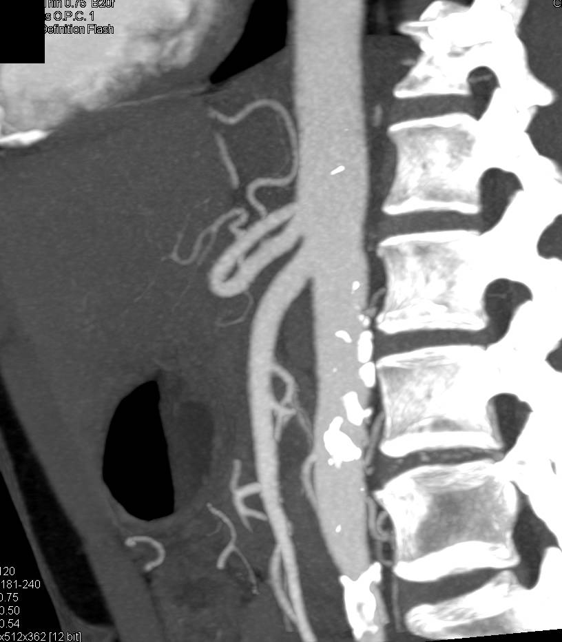 Mild Superior Mesenteric Artery (SMA) Stenosis - CTisus CT Scan
