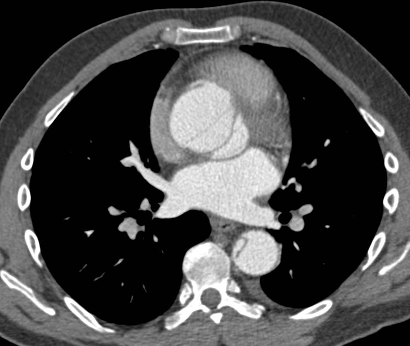 Type A Dissection in Multiple Perspectives - CTisus CT Scan