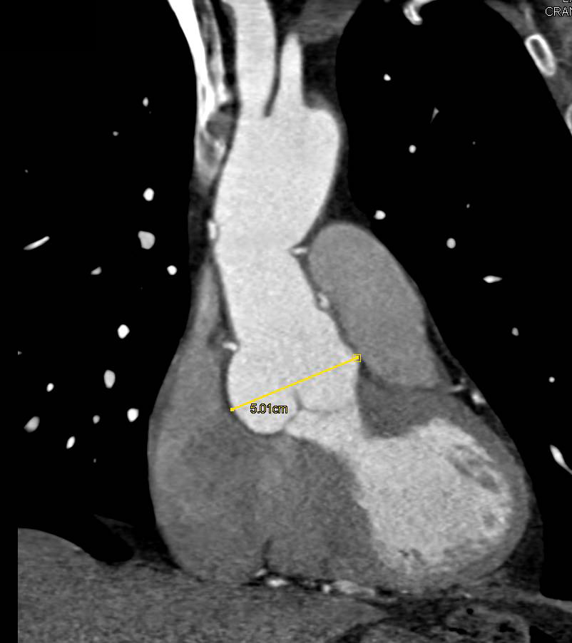 Dilated Sinus of Valsalva in a patient with Marfan Syndrome and Prior Ascending Aortic Repair - CTisus CT Scan
