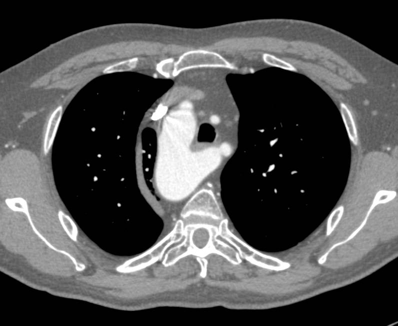 Right Aortic Arch with Aberrant Left Subclavian Artery - CTisus CT Scan