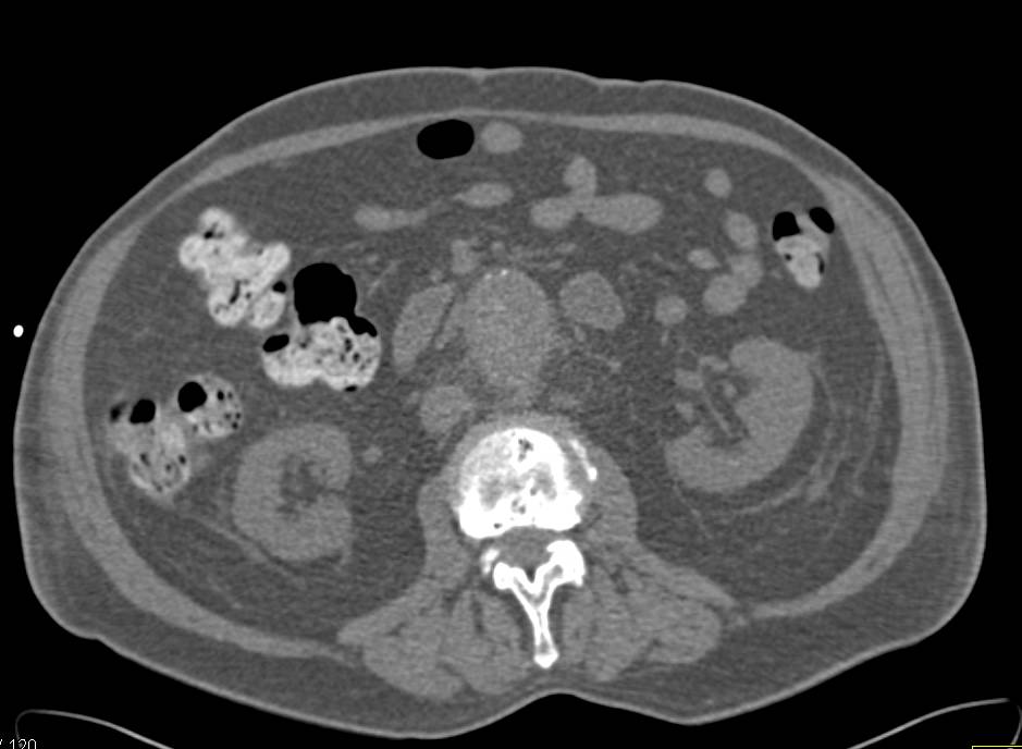 Aorto-Enteric Fistulae Involves the Duodenum - CTisus CT Scan