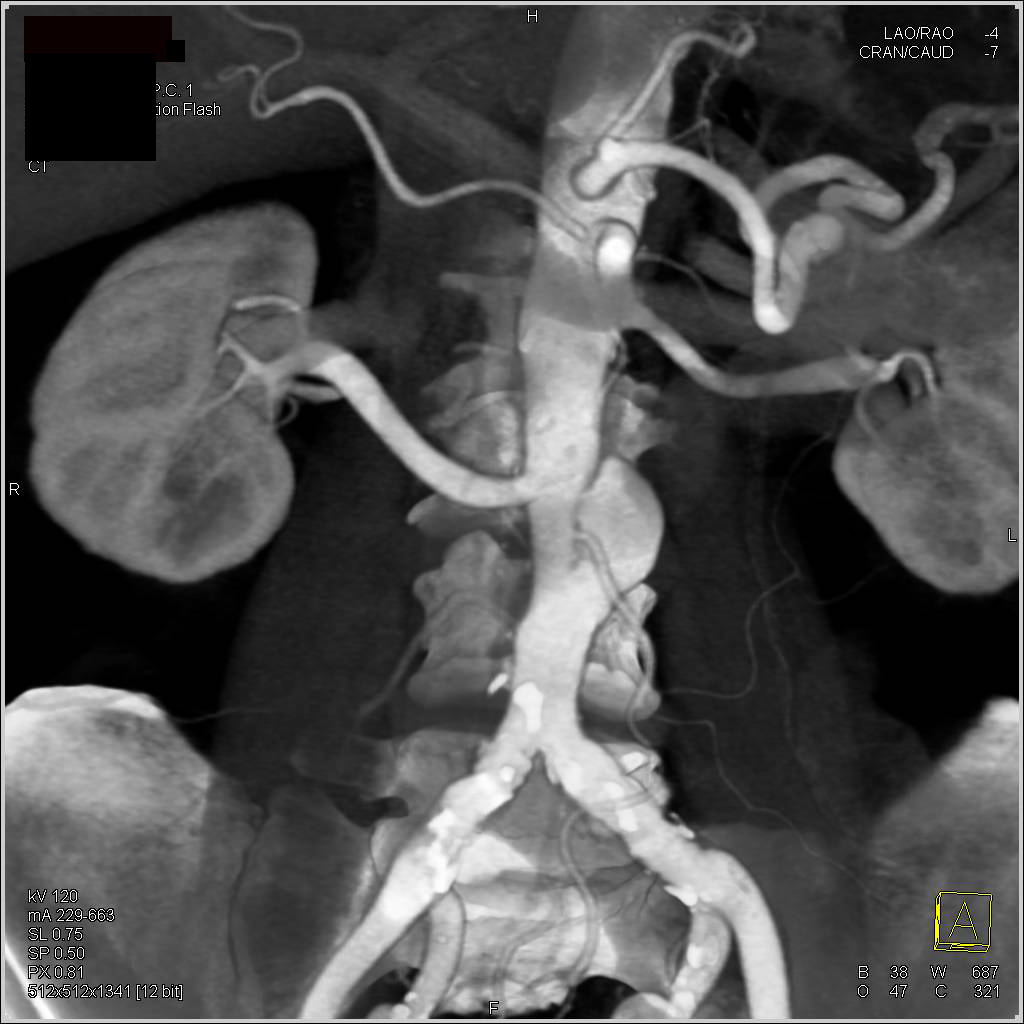 Focal Dissection of the Abdominal Aorta in 3D - CTisus CT Scan