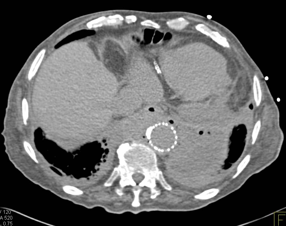 Infected Fluid Collection Around an Endovascular Stent - CTisus CT Scan