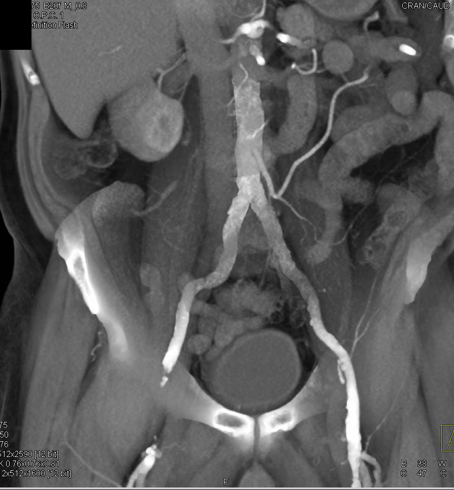 Dual Energy Runoff Study Comparing DE with Routine Bone Editing in Patient with Marked Peripheral Vascular Disease (PVD) - CTisus CT Scan