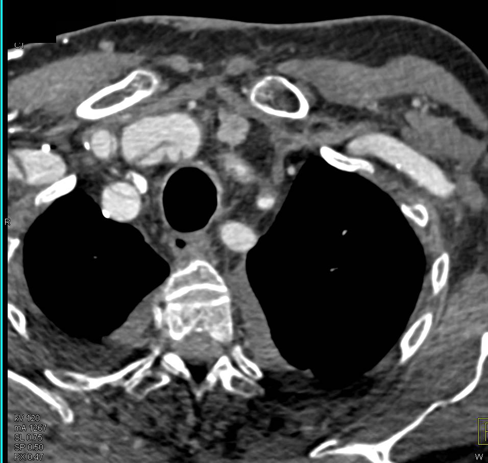 Aortic Dissection Extending into the Right Carotid Artery - CTisus CT Scan