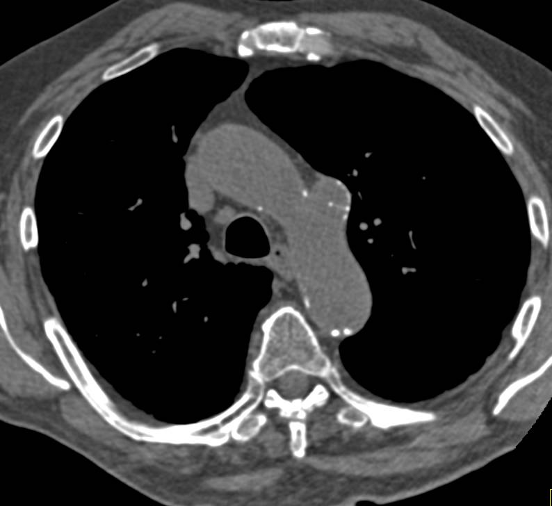 Ductus Aneurysm off the Arch - CTisus CT Scan