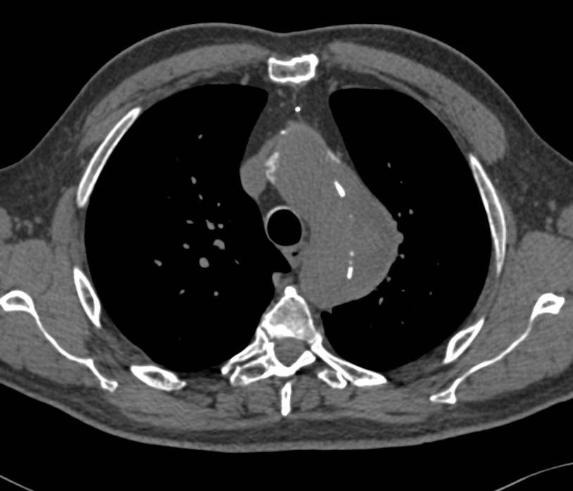 Aortic Root Repair with Dissection in 3D Extending to the Iliac Arteries - CTisus CT Scan