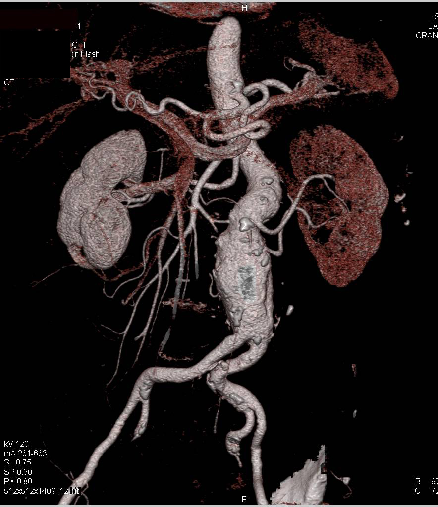 Infra-Renal Aortic Aneurysm with Vessel Tracking - CTisus CT Scan