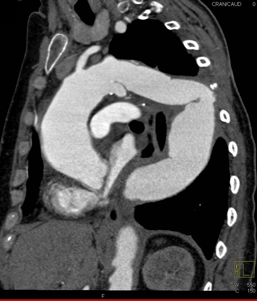 Dilated Ascending Aorta with Focal Dissection in Arch - CTisus CT Scan