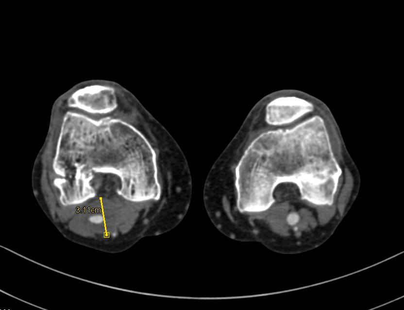 CTA with Multiple Aneurysms Including a Popliteal Artery Aneurysm - CTisus CT Scan