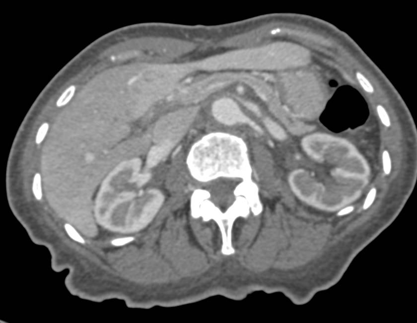 Celiac and Superior Mesenteric Artery (SMA) Arise from a Common Trunk - CTisus CT Scan